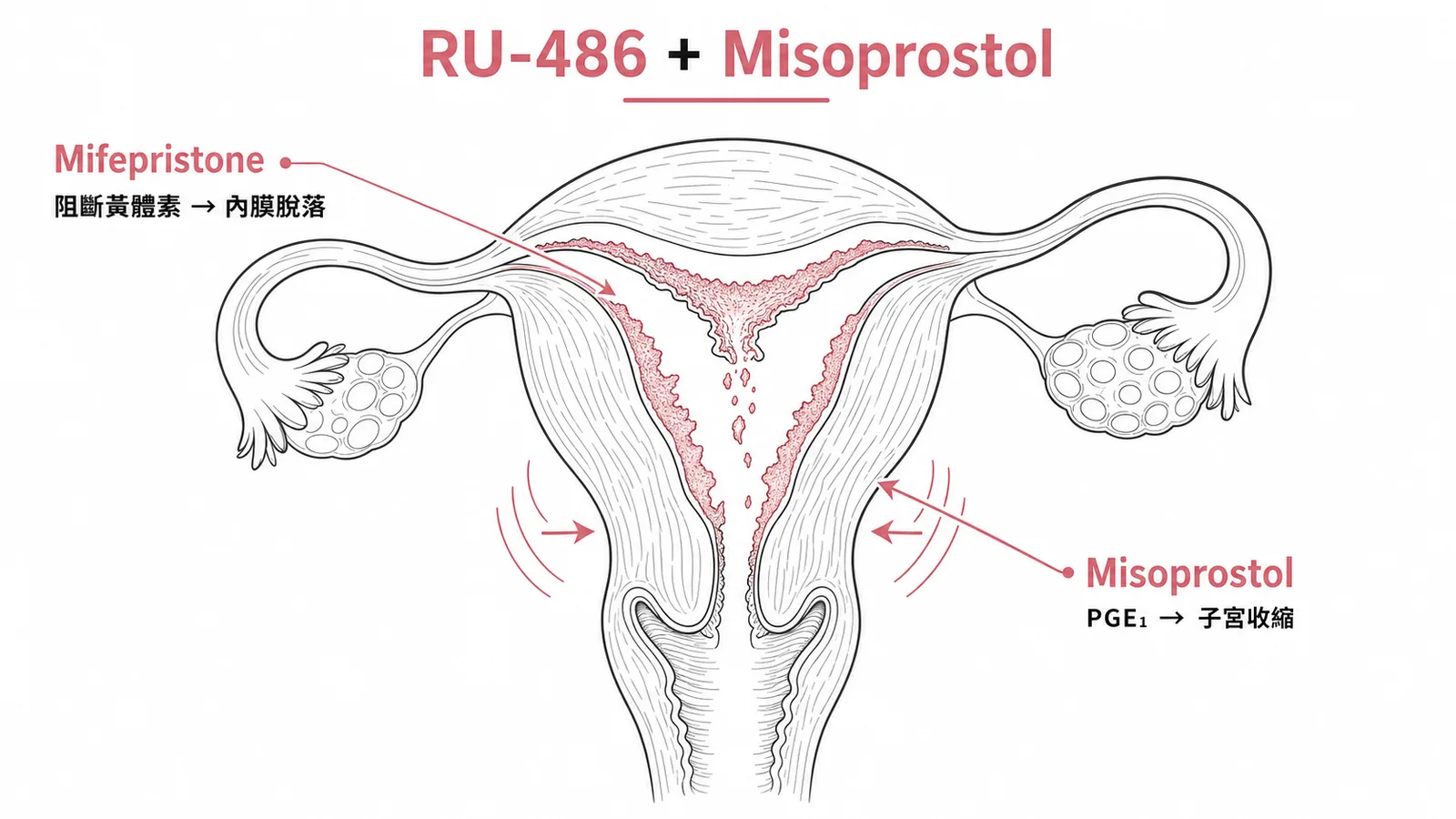Mifepristone 阻斷黃體素加 Misoprostol 收縮子宮的藥物流產組合