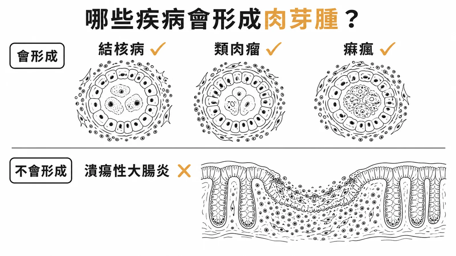 結核病、類肉瘤、痲瘋形成肉芽腫；潰瘍性大腸炎不會