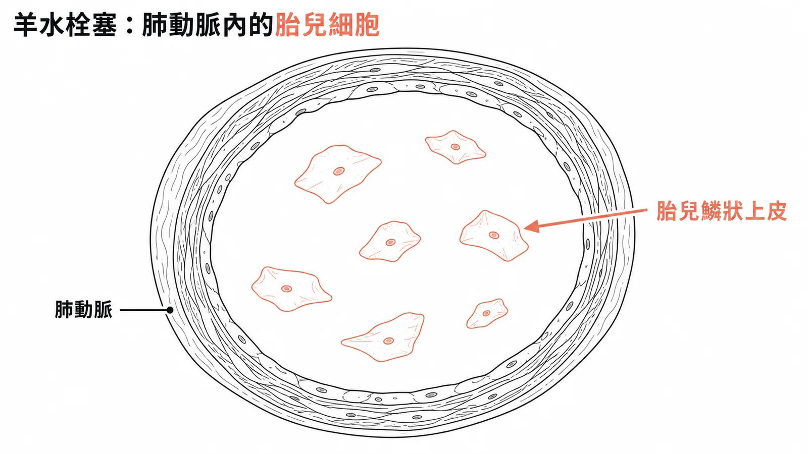 羊水栓塞：肺動脈管腔內可見胎兒鱗狀上皮細胞