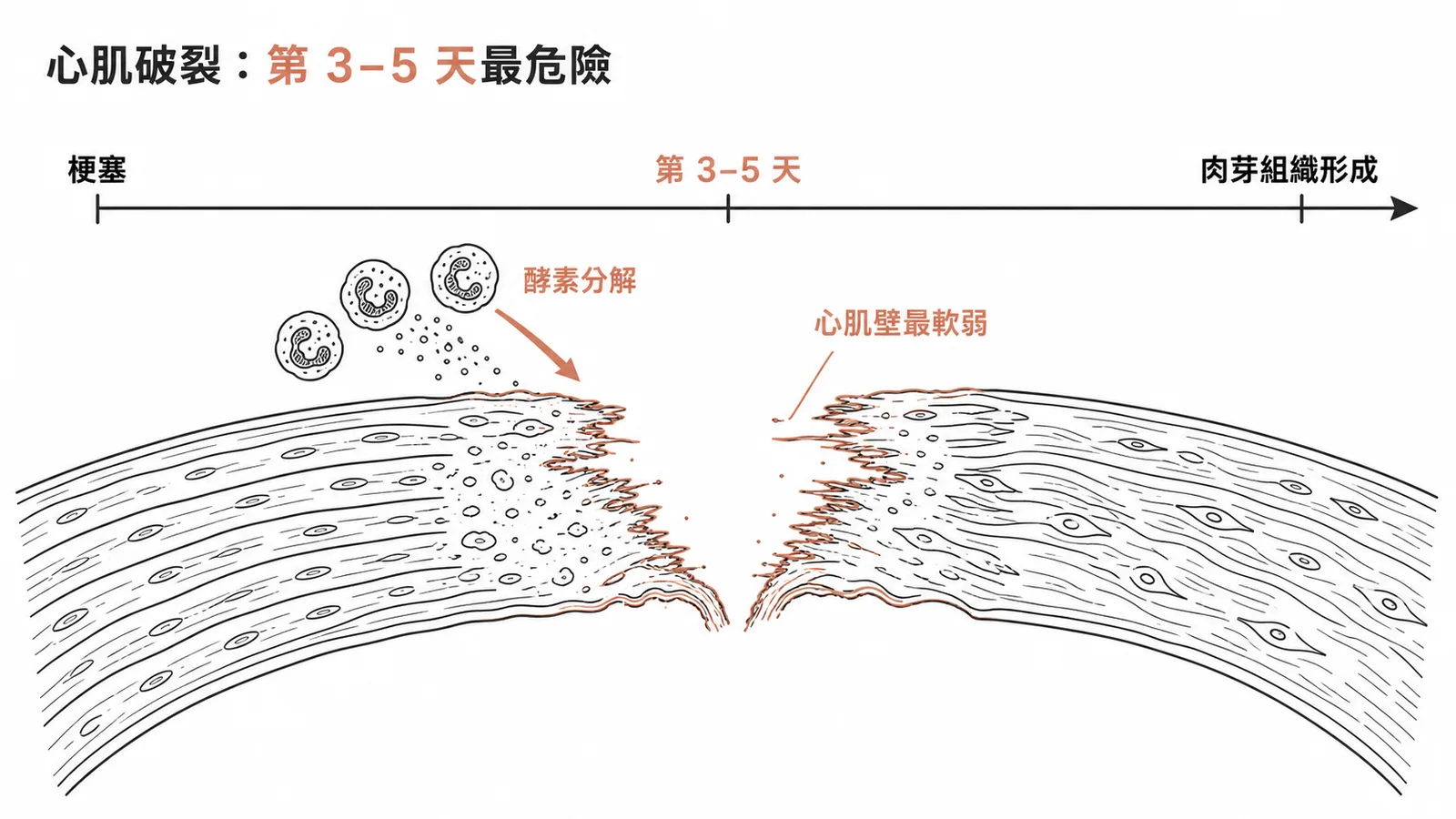 心肌梗塞後第3-5天心肌壁最軟化，是破裂高峰期