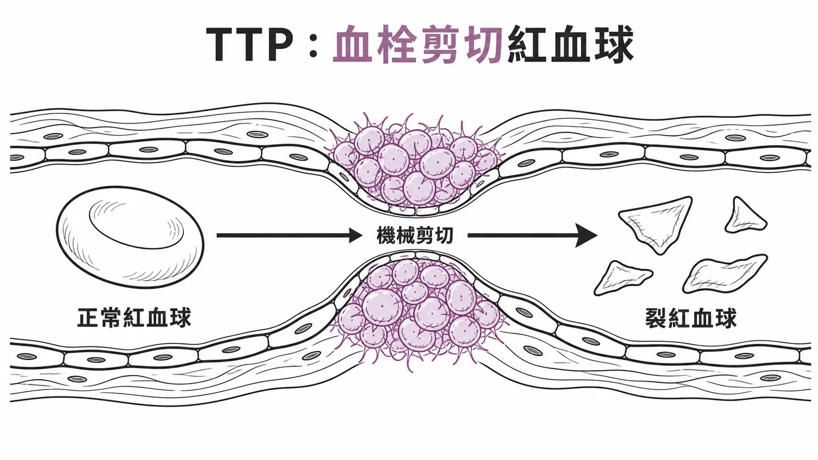 TTP血小板血栓在微血管內機械剪切紅血球形成裂紅血球