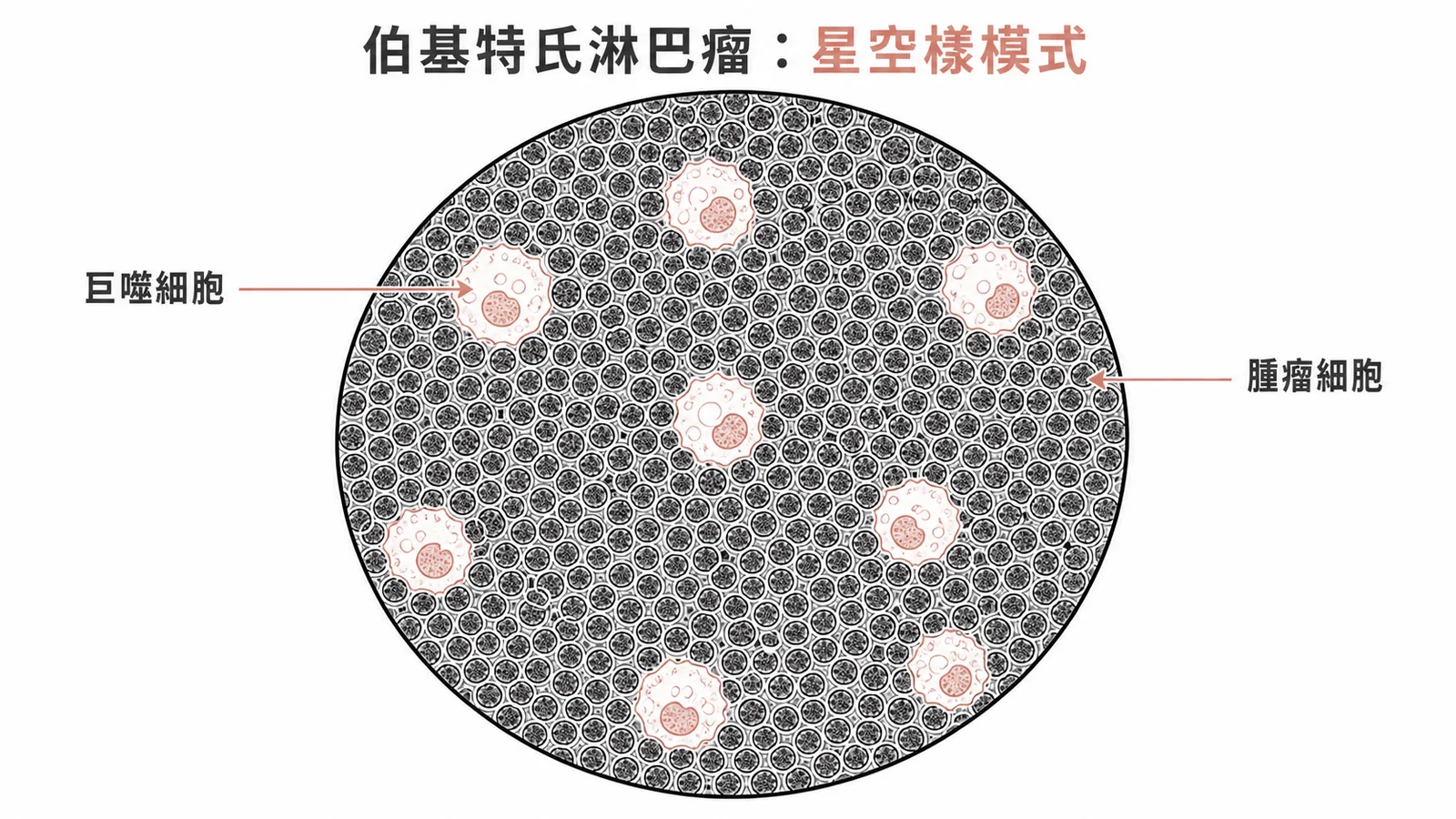 伯基特氏淋巴瘤星空樣模式：密集腫瘤細胞中散布巨噬細胞
