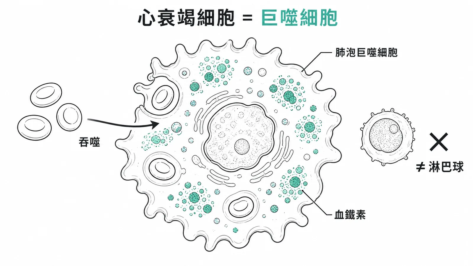 心衰竭細胞是肺泡巨噬細胞吞噬血鐵素後形成，非淋巴球