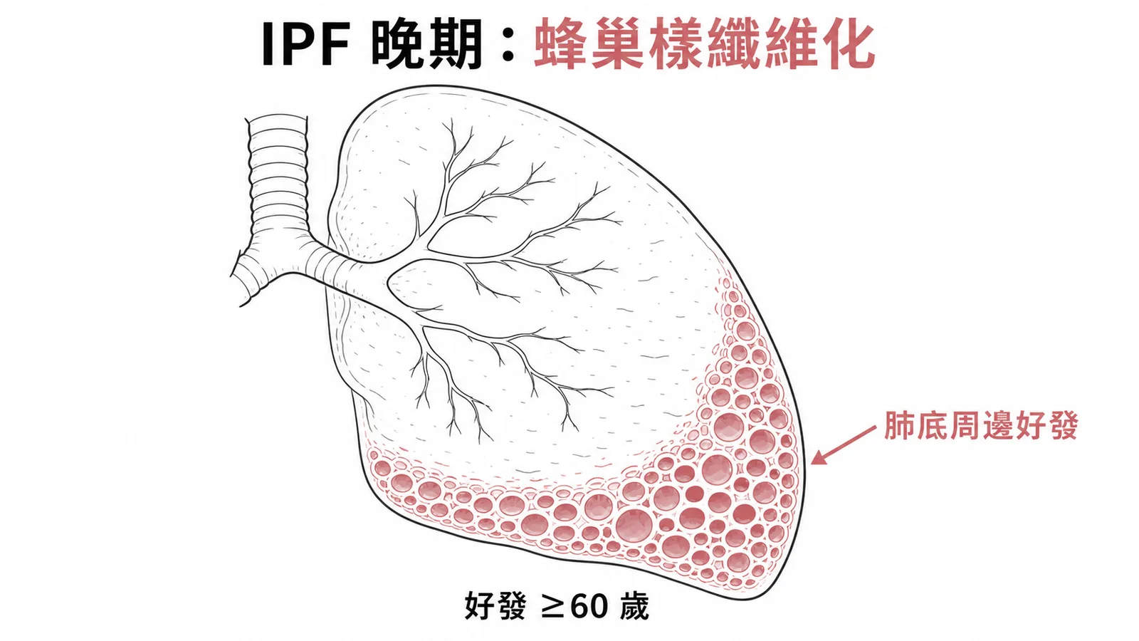 IPF晚期蜂巢樣纖維化好發肺底周邊，常見於60歲以上