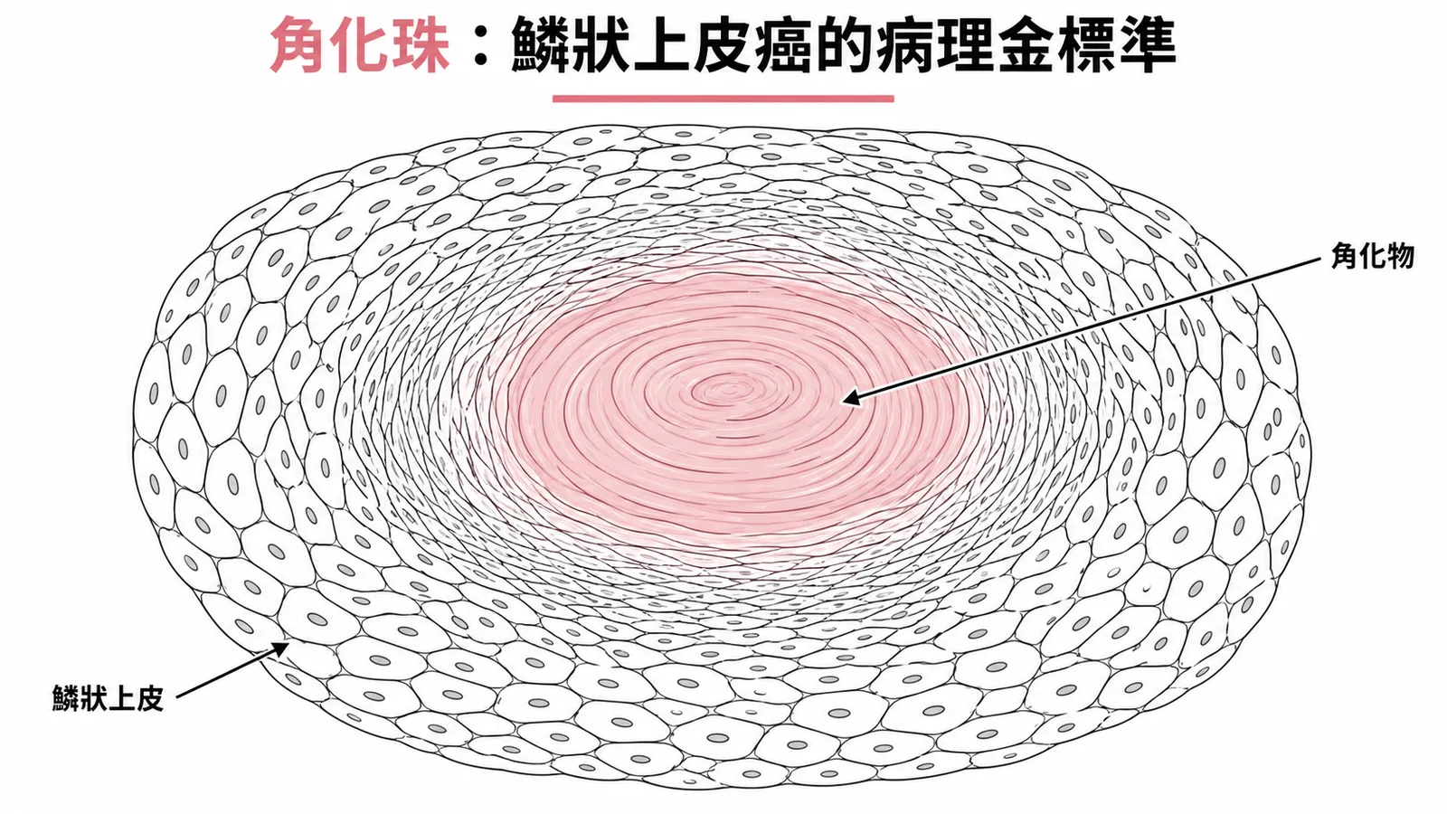 角化珠是鱗狀上皮細胞癌的標誌性病理特徵
