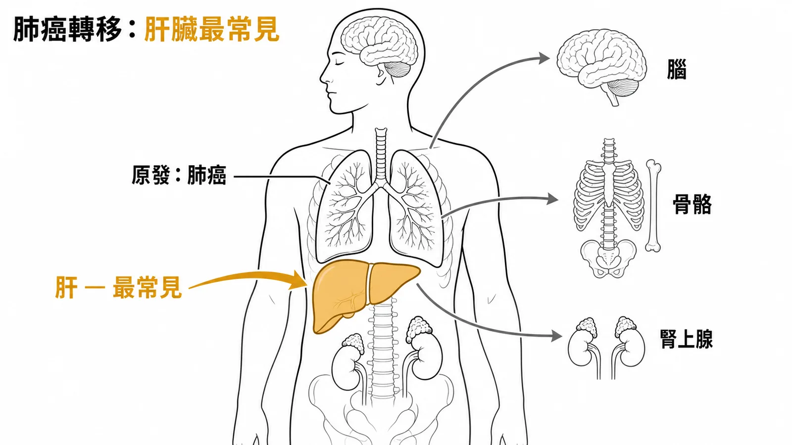 肺癌遠端轉移最常見部位為肝臟，其次為腦、骨骼、腎上腺