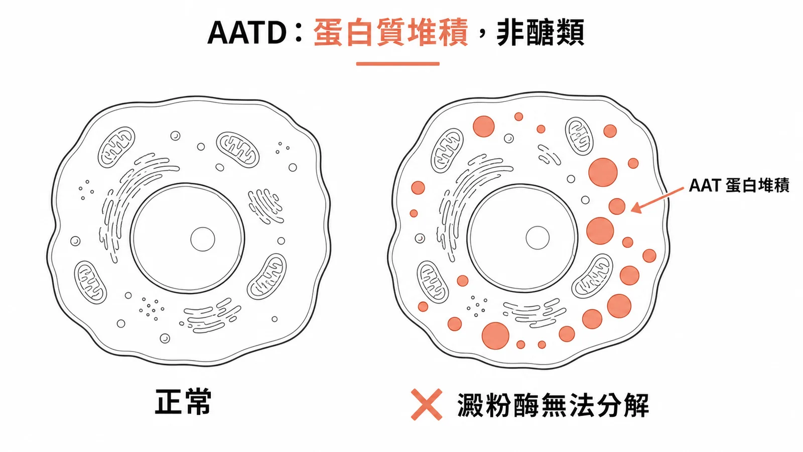 AATD肝細胞內堆積AAT蛋白質球狀內含物，澱粉酶無法分解
