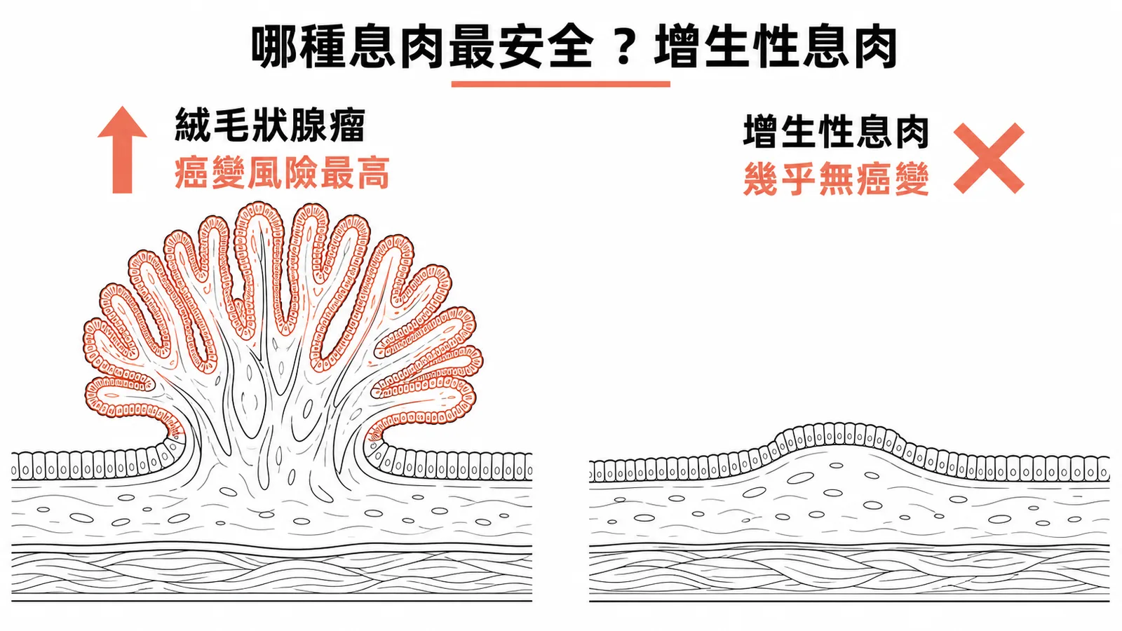 增生性息肉幾乎無癌變風險，絨毛狀腺瘤癌變風險最高