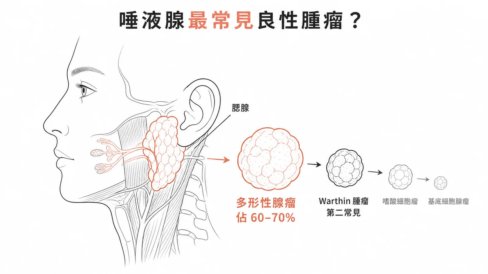 唾液腺良性腫瘤種類與發生率比較——多形性腺瘤佔60-70%為最常見