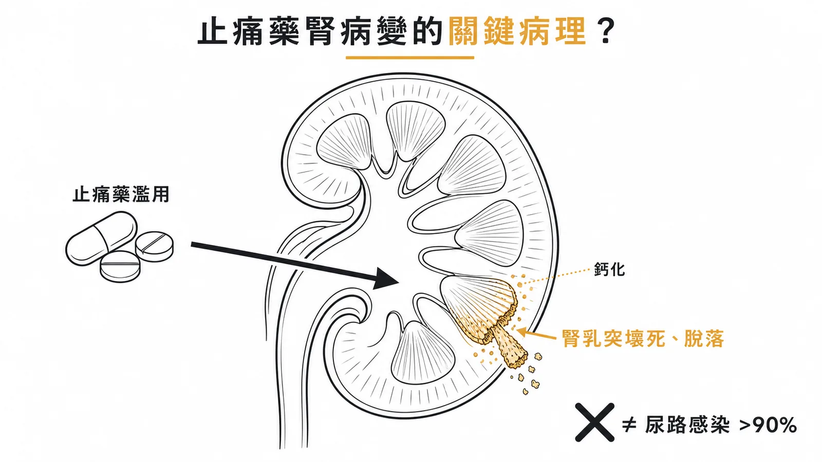 止痛藥腎病變的關鍵病理——腎乳突壞死與鈣化，尿路感染非主要併發症
