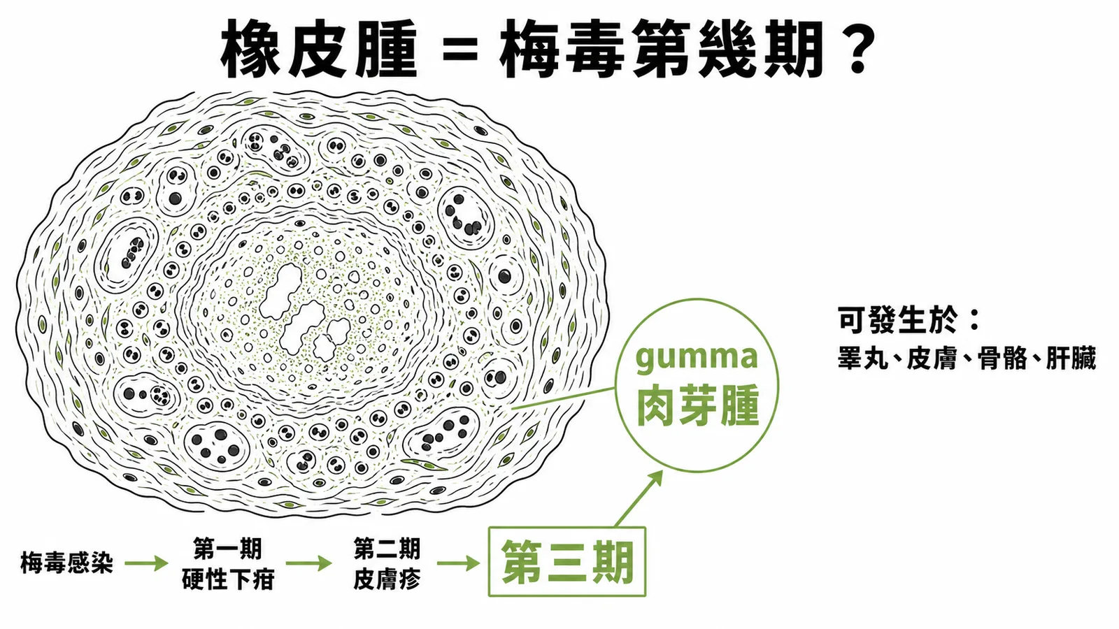橡皮腫是梅毒第三期的典型肉芽腫性病灶