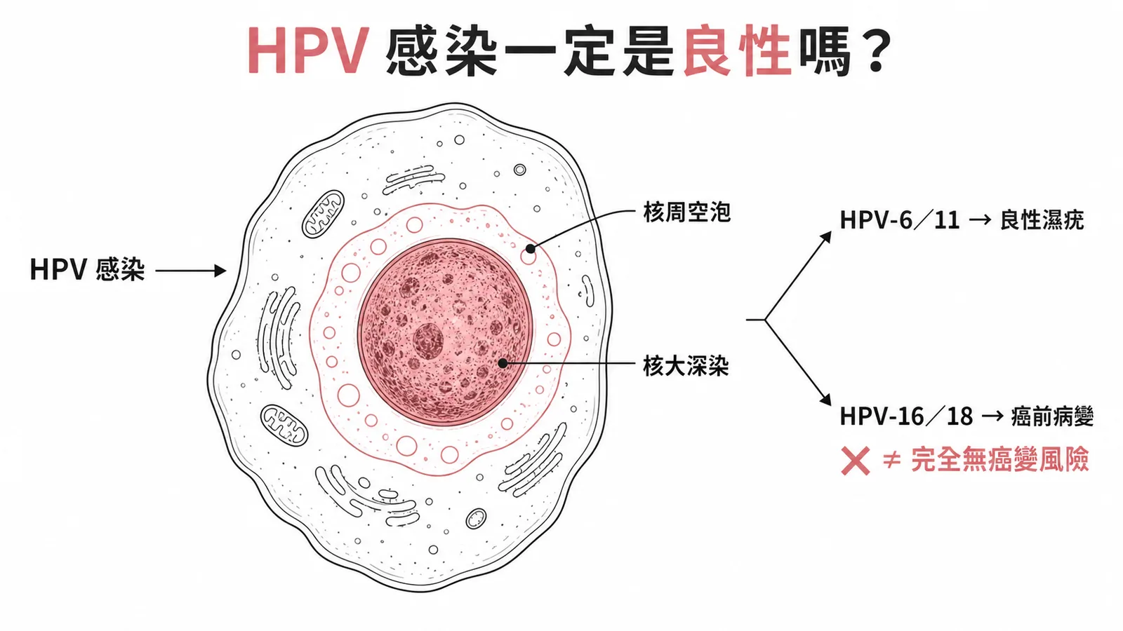 HPV低風險型與高風險型對照——空泡狀異常細胞與癌變風險