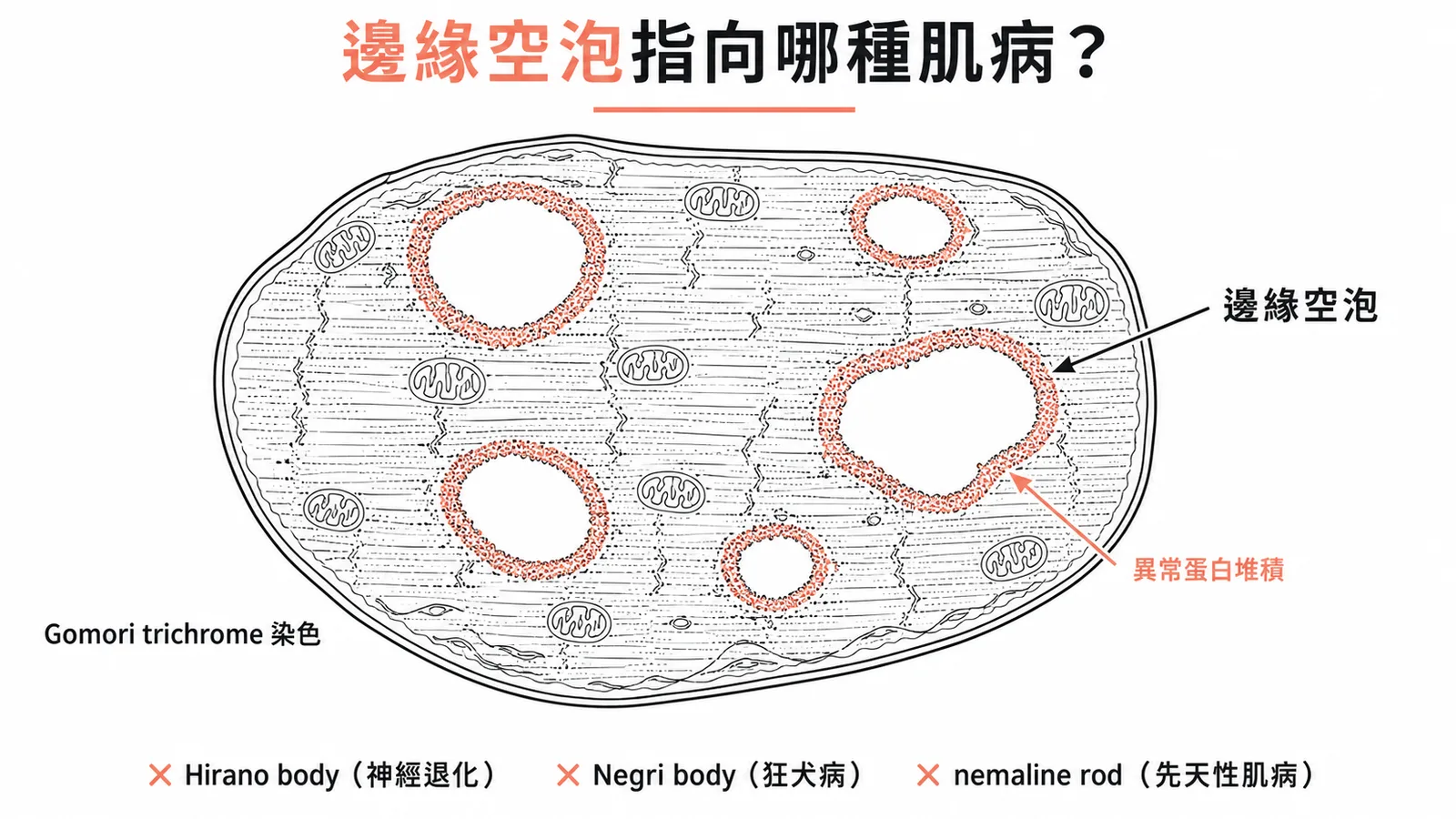 包涵體肌炎的邊緣空泡——Gomori trichrome染色下的診斷性病理特徵
