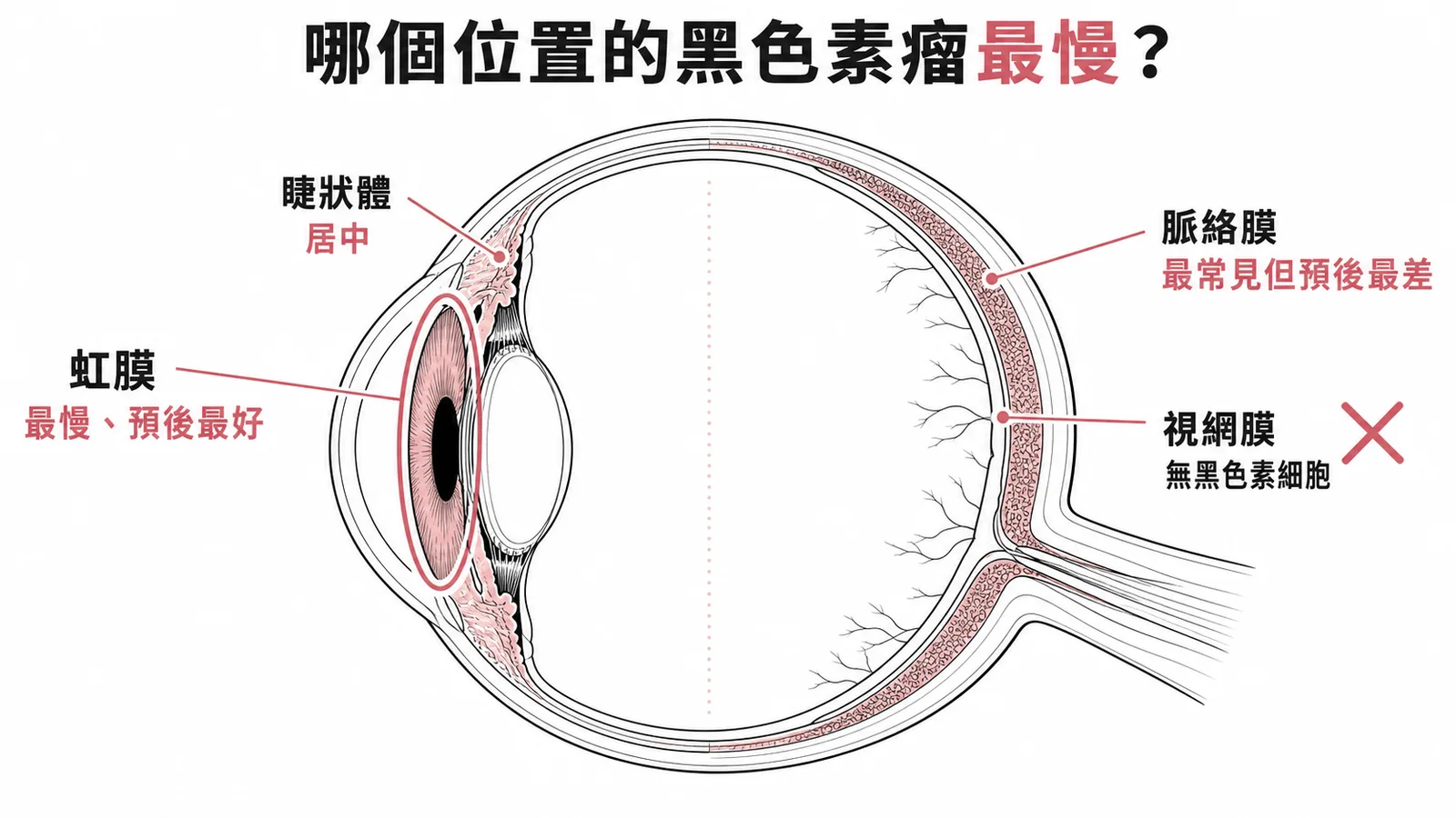 葡萄膜黑色素瘤位置與預後——虹膜最慢、脈絡膜最差