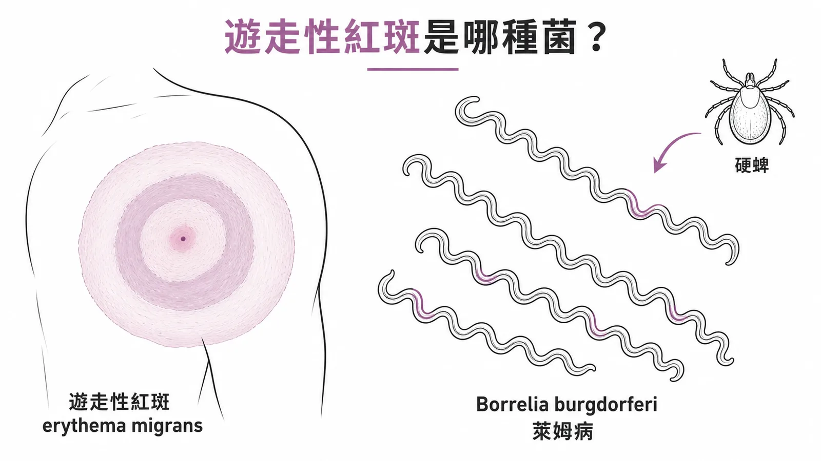 遊走性紅斑由Borrelia burgdorferi經硬蜱叮咬引起萊姆病