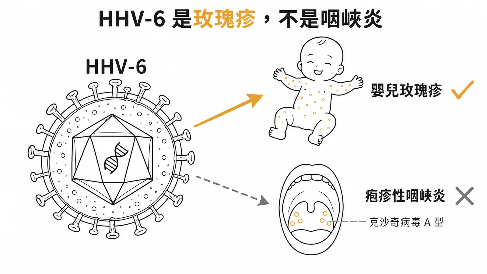HHV-6引起嬰兒玫瑰疹而非疱疹性咽峽炎,咽峽炎應配對克沙奇病毒A型