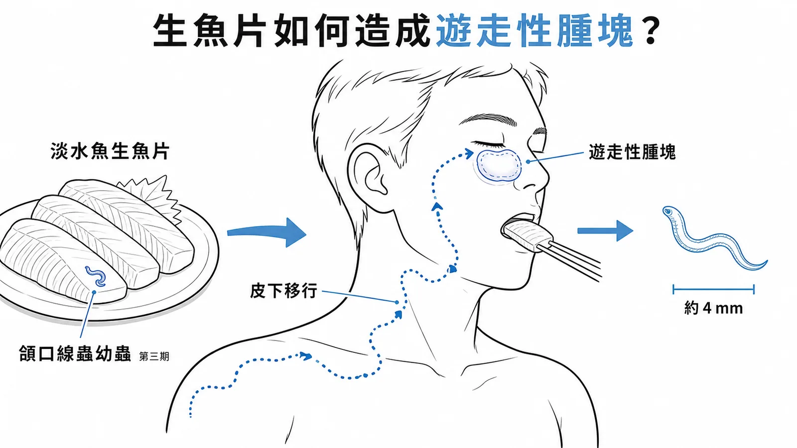 頜口線蟲感染路徑：淡水魚生魚片經口攝入後幼蟲皮下移行造成遊走性腫塊