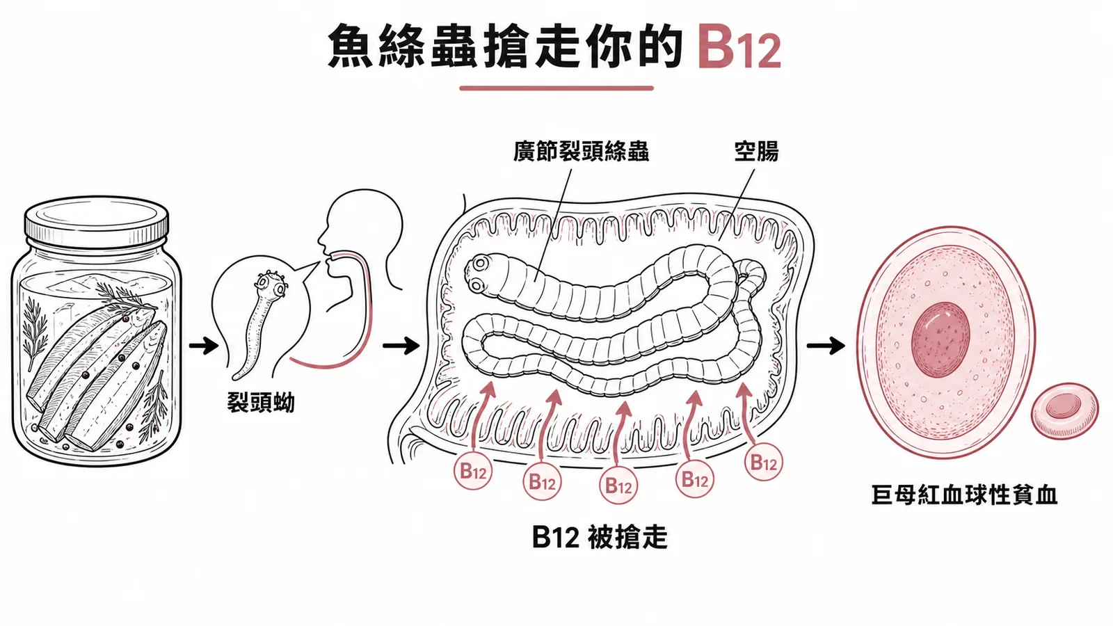 廣節裂頭絛蟲寄生空腸搶走維他命B12導致巨母紅血球性貧血