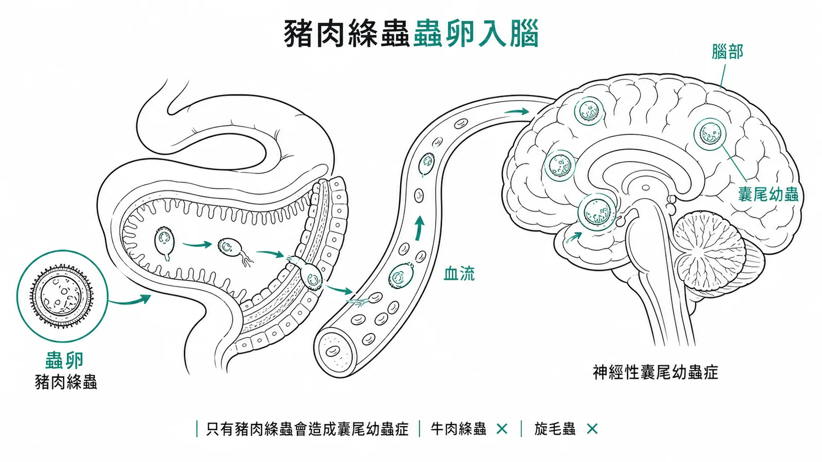 豬肉絛蟲蟲卵經腸道入血流移行至腦部形成囊尾幼蟲