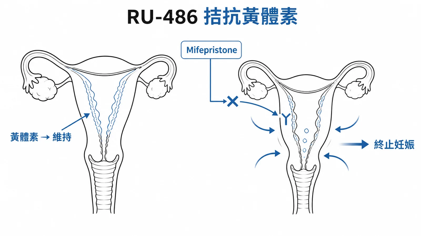 Mifepristone 拮抗黃體素受體,導致子宮內膜退化與收縮而終止妊娠