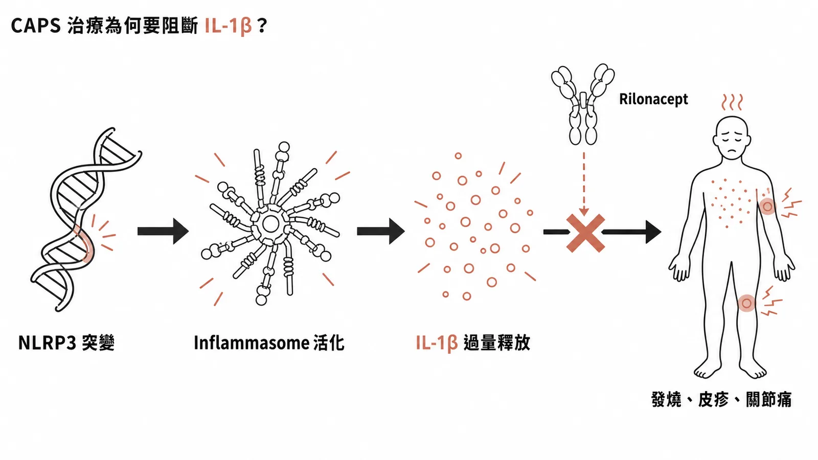 CAPS致病機轉與Rilonacept阻斷IL-1β示意圖