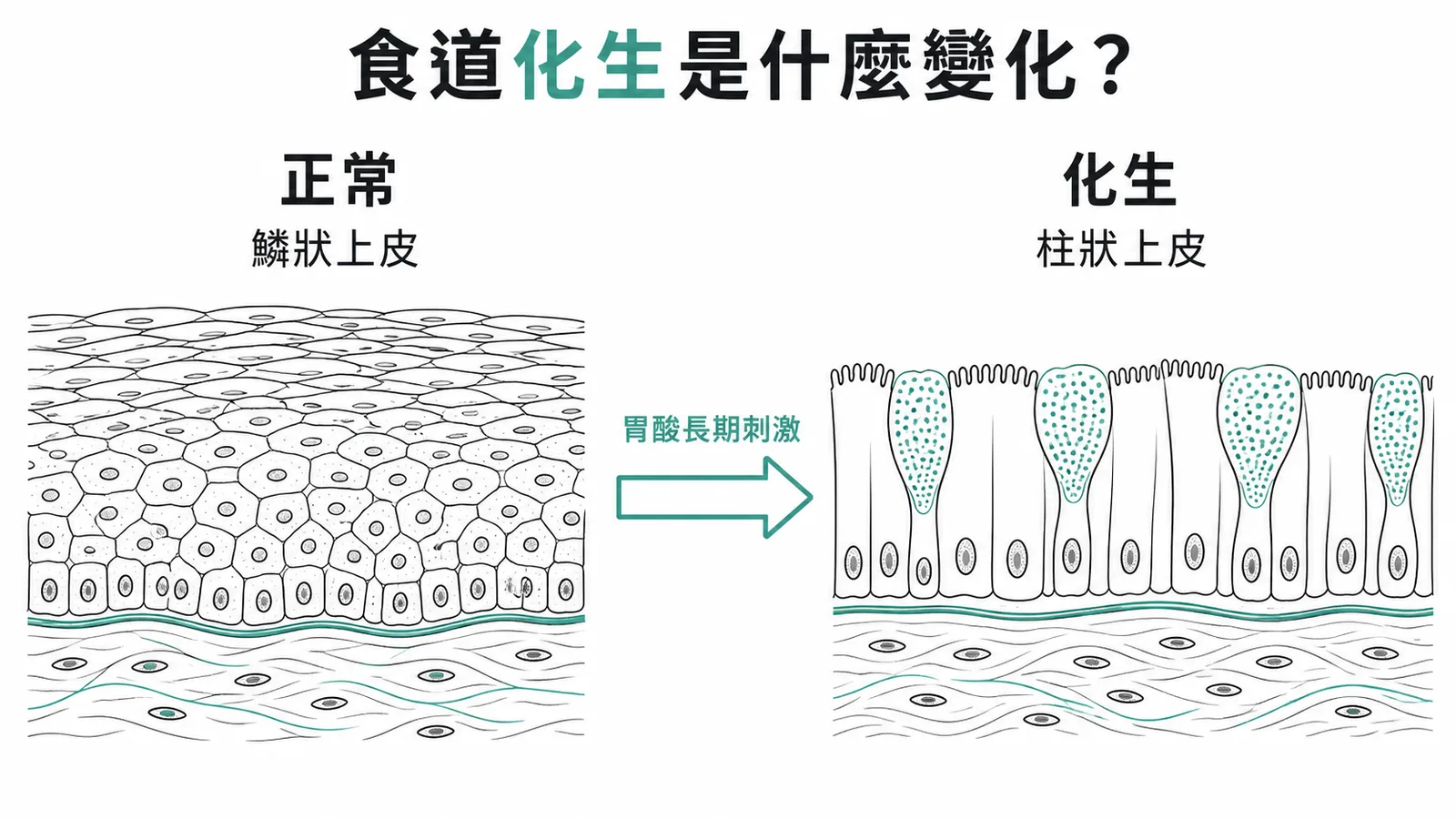 食道化生鱗狀上皮轉為柱狀上皮對比示意圖