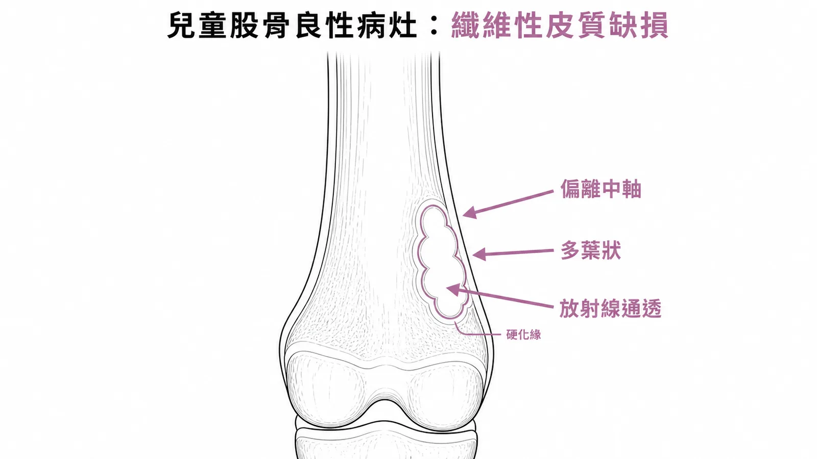 纖維性皮質缺損的X光特徵:偏離中軸、多葉狀、放射線通透的良性病灶