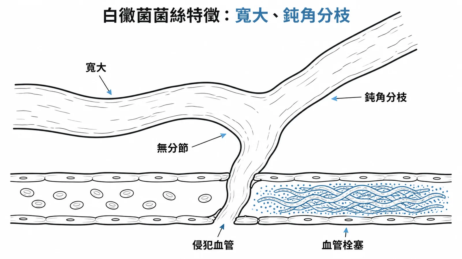 白黴菌菌絲特徵:寬大無分節、鈍角分枝、侵犯血管