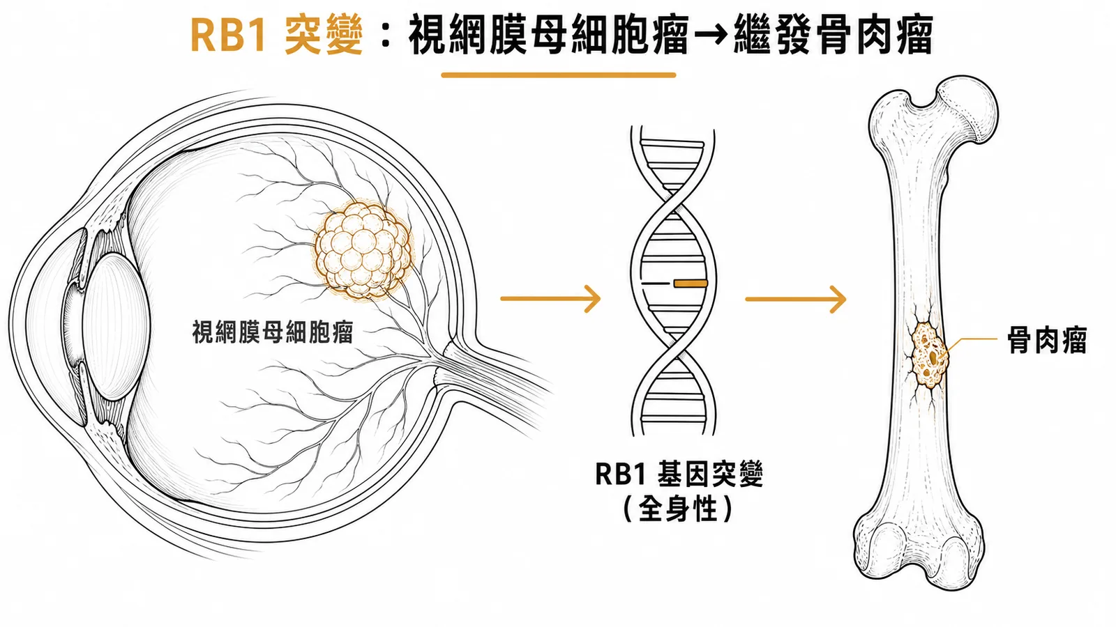RB1基因突變導致視網膜母細胞瘤繼發骨肉瘤