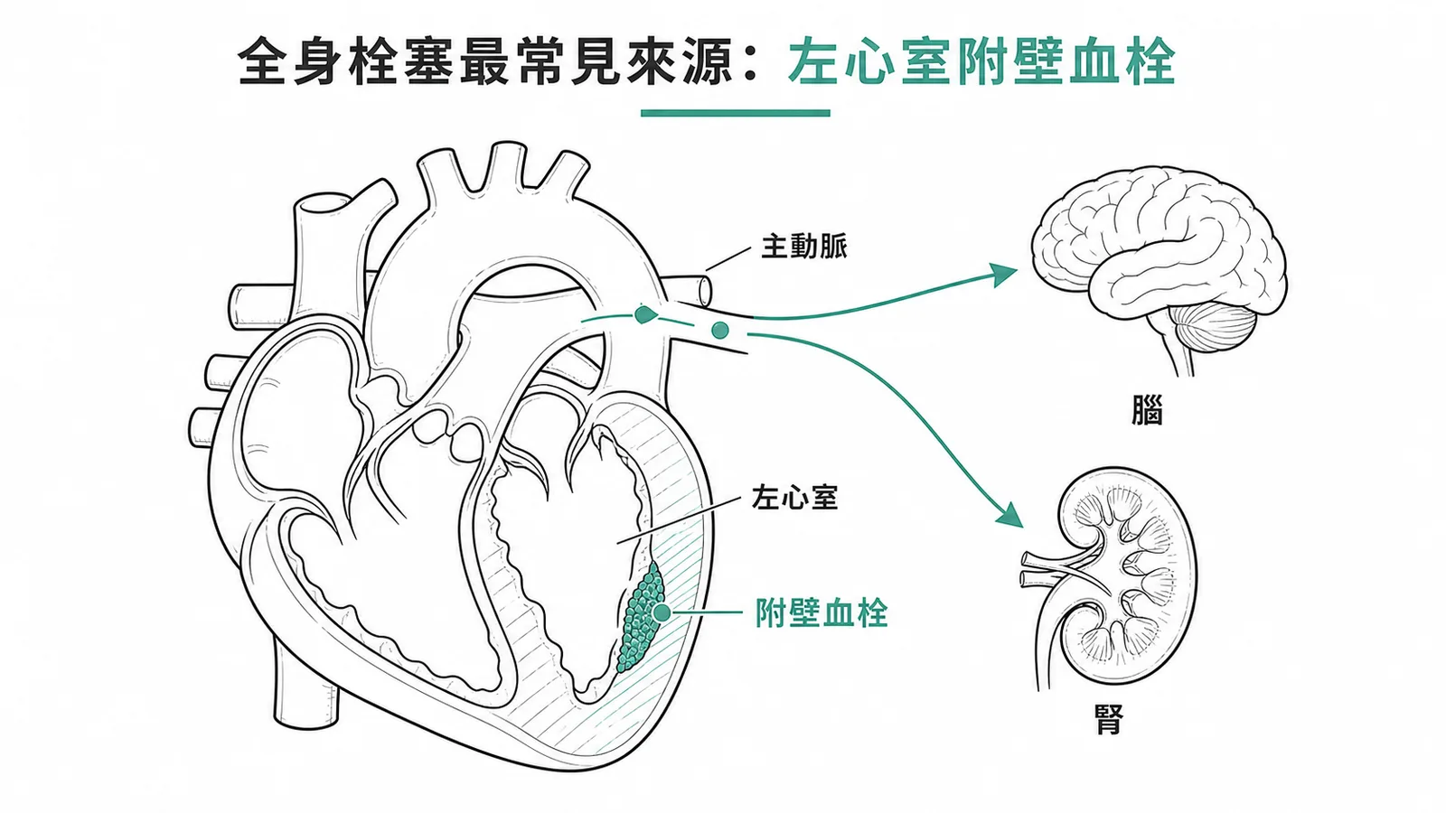 全身性栓塞最常見來源:左心室附壁血栓經主動脈到遠端器官