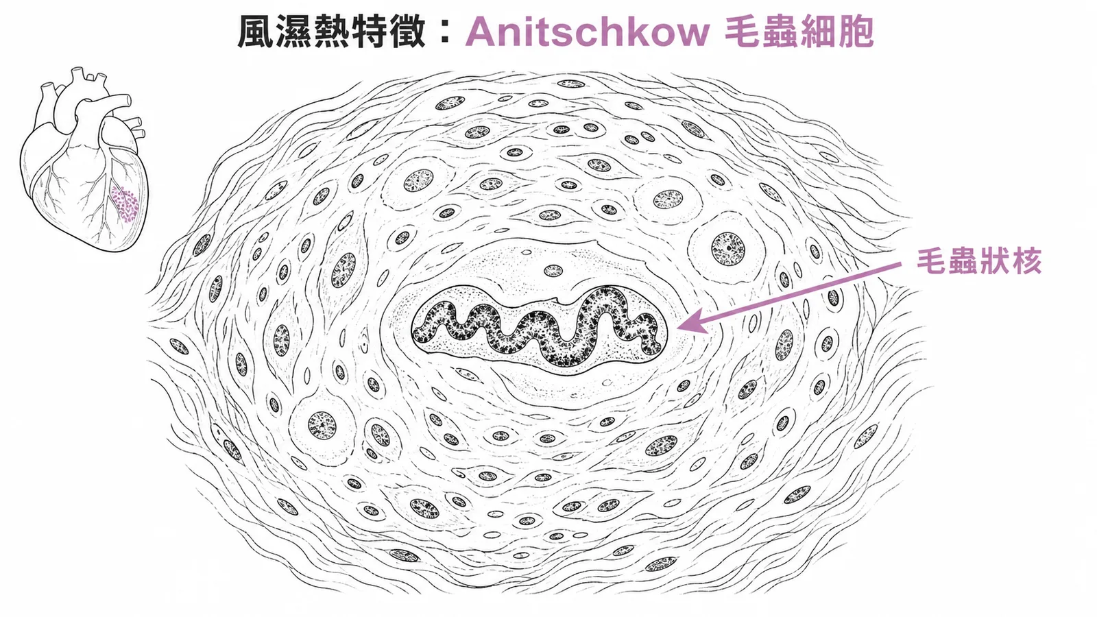風濕熱Aschoff小體中的Anitschkow毛蟲細胞及其波浪狀核