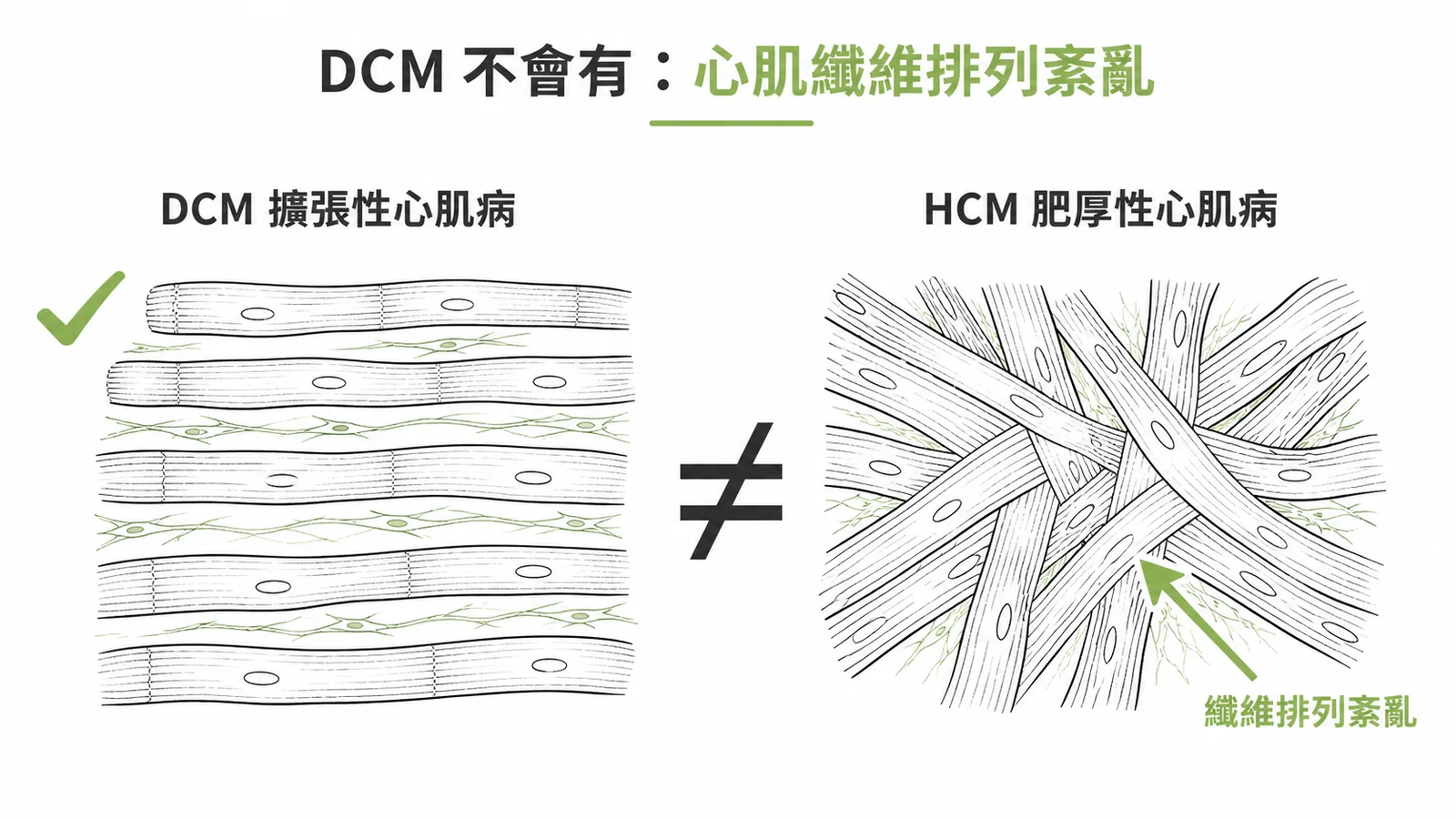 擴張性心肌病與肥厚性心肌病的心肌纖維排列差異