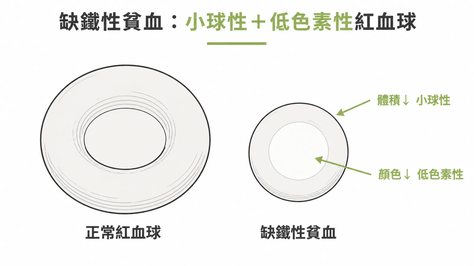 缺鐵性貧血紅血球特徵:體積變小且中央蒼白區擴大