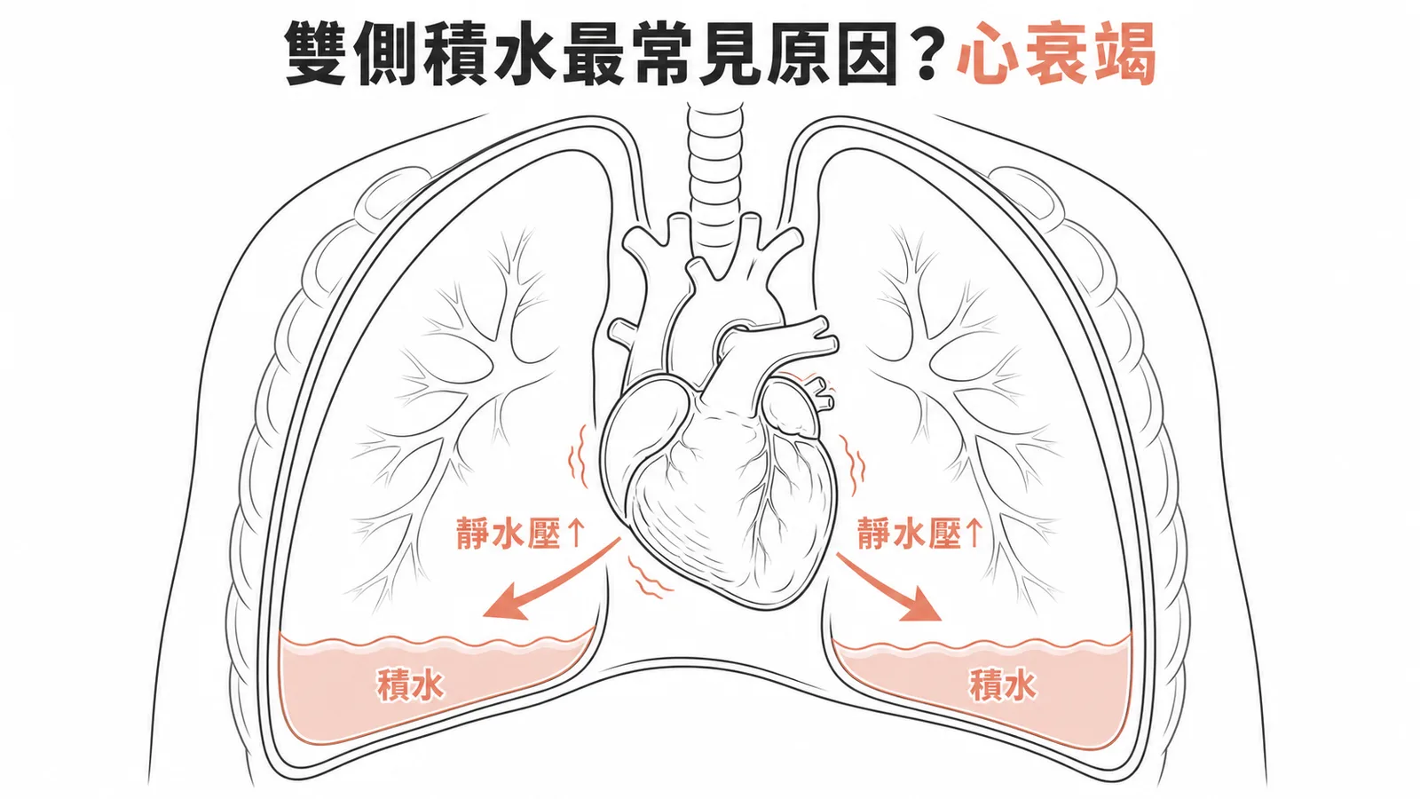 雙側胸膜積水最常見原因為心衰竭,靜水壓升高導致雙側漏出液