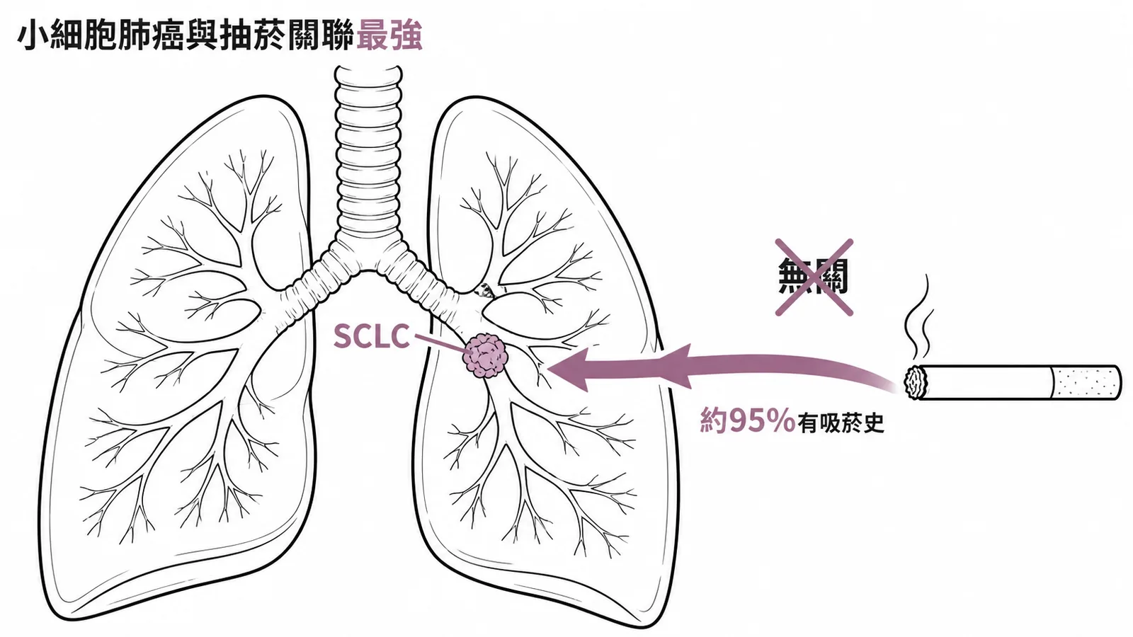 小細胞肺癌與抽菸關聯性最強,約95%患者有吸菸史