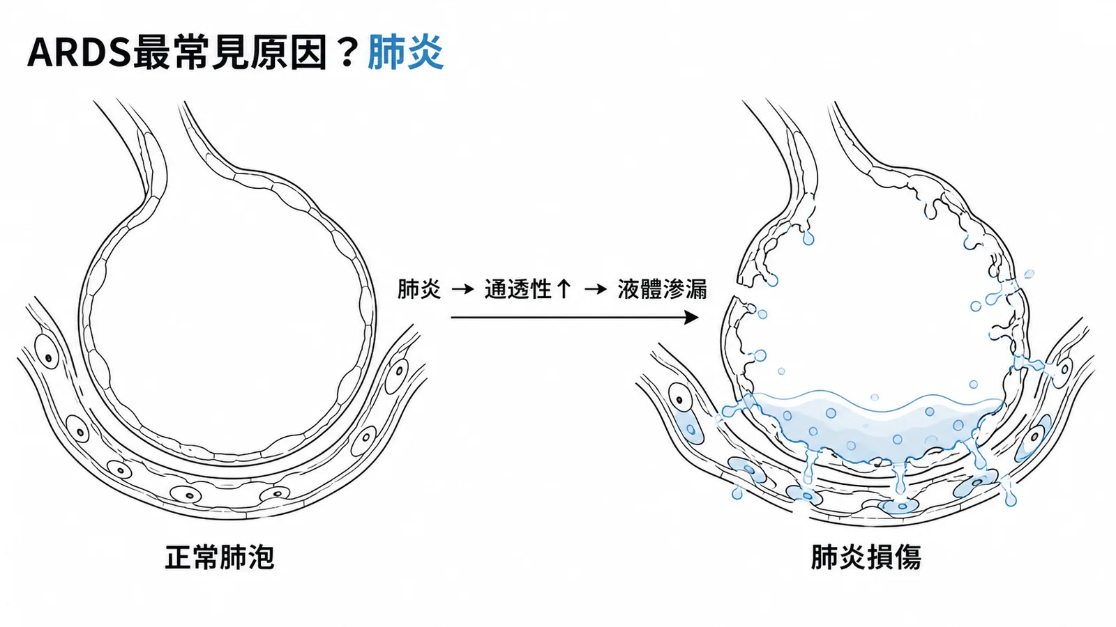 ARDS最常見原因為肺炎,直接損傷肺泡導致通透性增加與液體滲漏