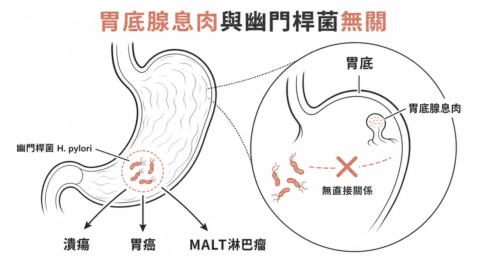 胃底腺息肉與幽門桿菌無直接關係,H. pylori主要關聯潰瘍、胃癌及MALT淋巴瘤