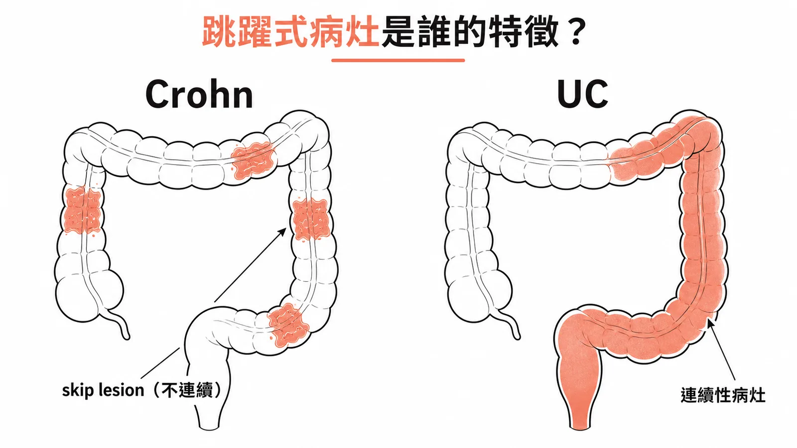 跳躍式病灶是克隆氏症特徵,潰瘍性結腸炎為連續性病灶