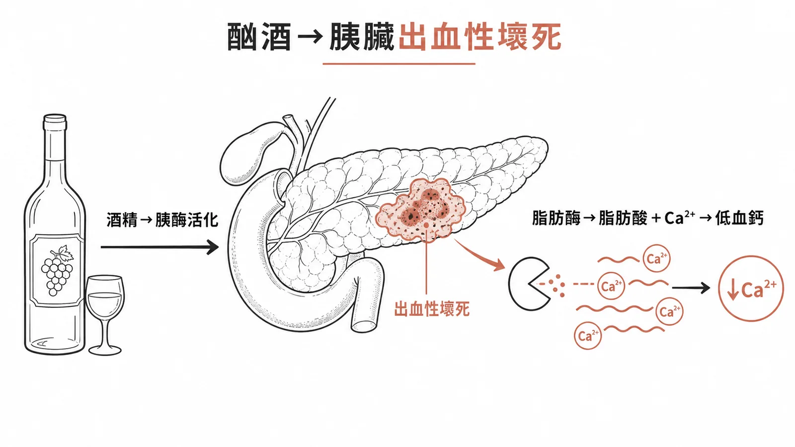 酗酒引發急性胰臟炎,嚴重時導致出血性壞死與低血鈣