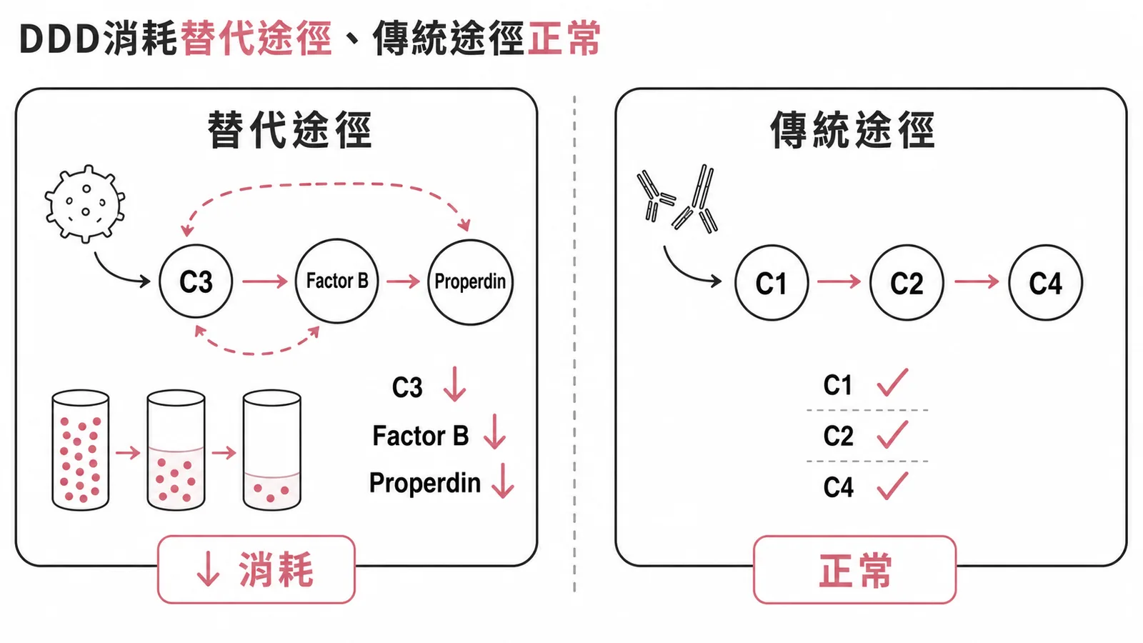 DDD消耗替代途徑補體(C3、Factor B、Properdin),傳統途徑C1維持正常
