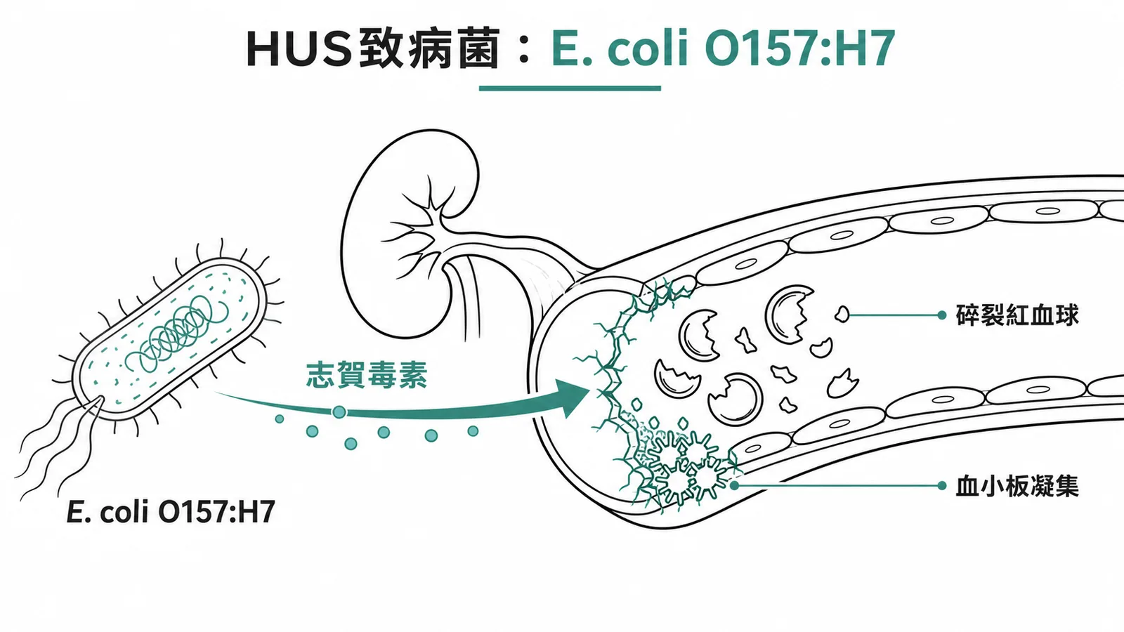 典型HUS由E. coli O157:H7志賀毒素損傷腎臟微血管引起