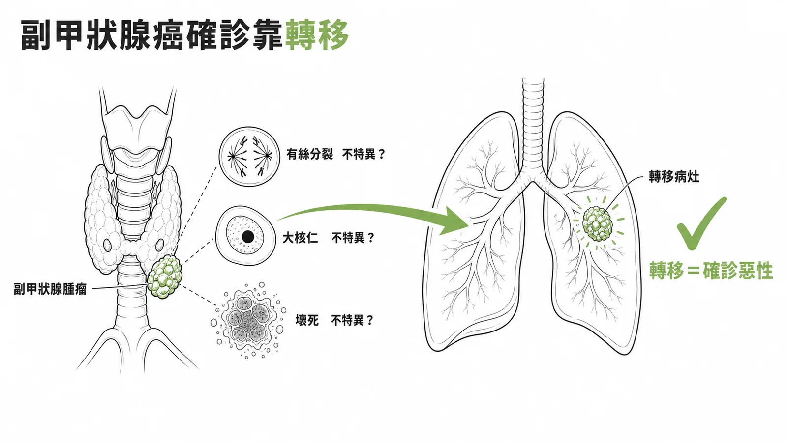 副甲狀腺癌最可靠的診斷條件是腫瘤轉移,其他組織學特徵不具特異性