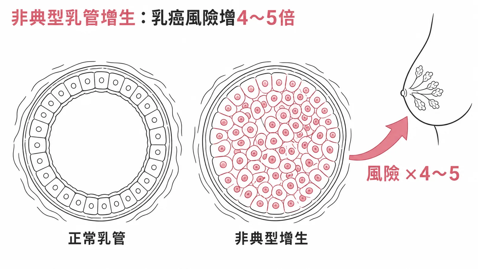 非典型乳管增生是乳癌癌前病變,使罹癌風險增加4至5倍