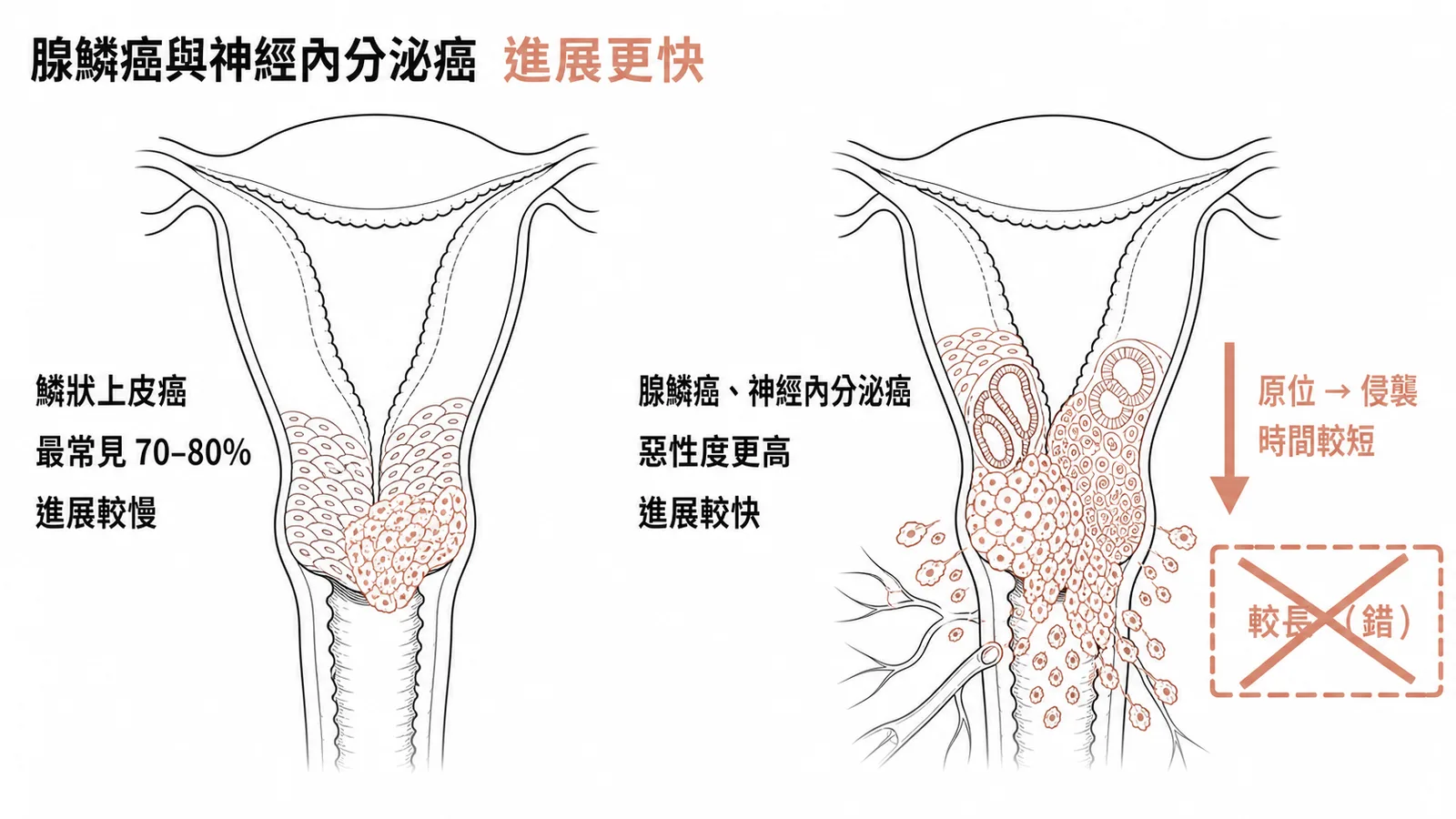 子宮頸癌各組織型惡性度比較:腺鱗癌與神經內分泌癌進展更快