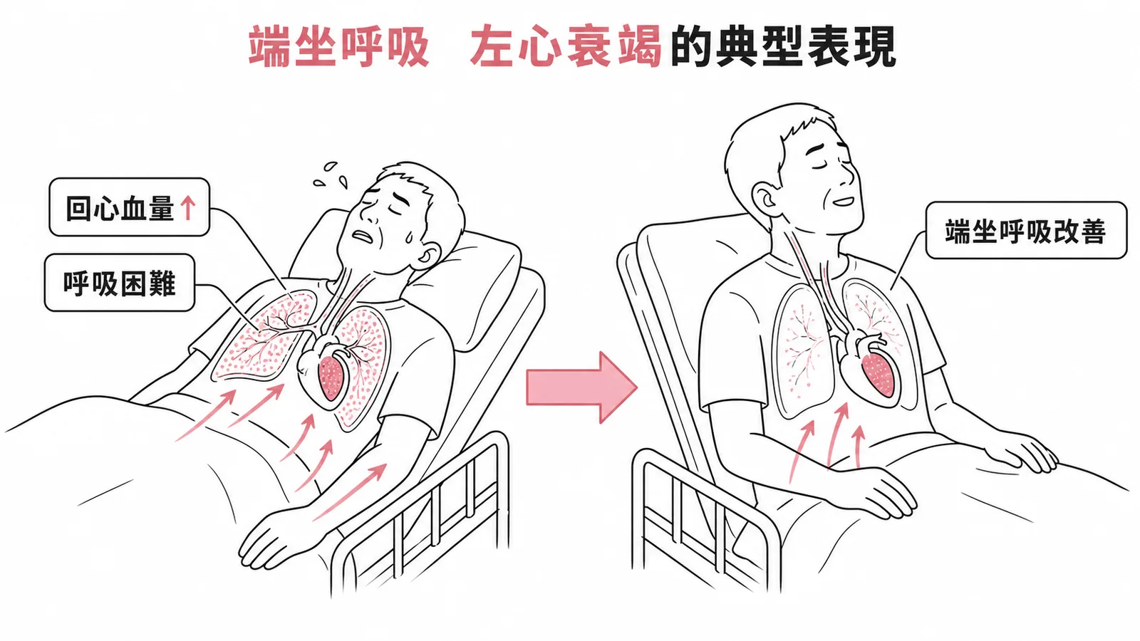端坐呼吸機轉：平躺時回心血量增加致肺充血，坐起後改善，為左心衰竭典型表現