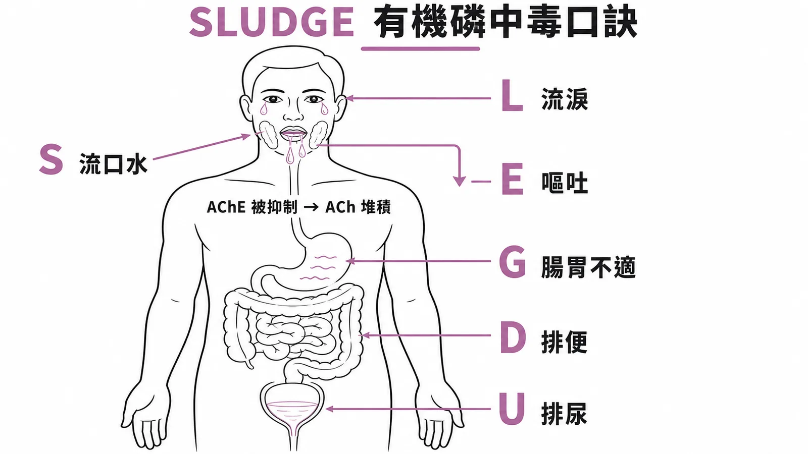 有機磷中毒SLUDGE口訣：流口水、流淚、排尿、排便、腸胃不適、嘔吐