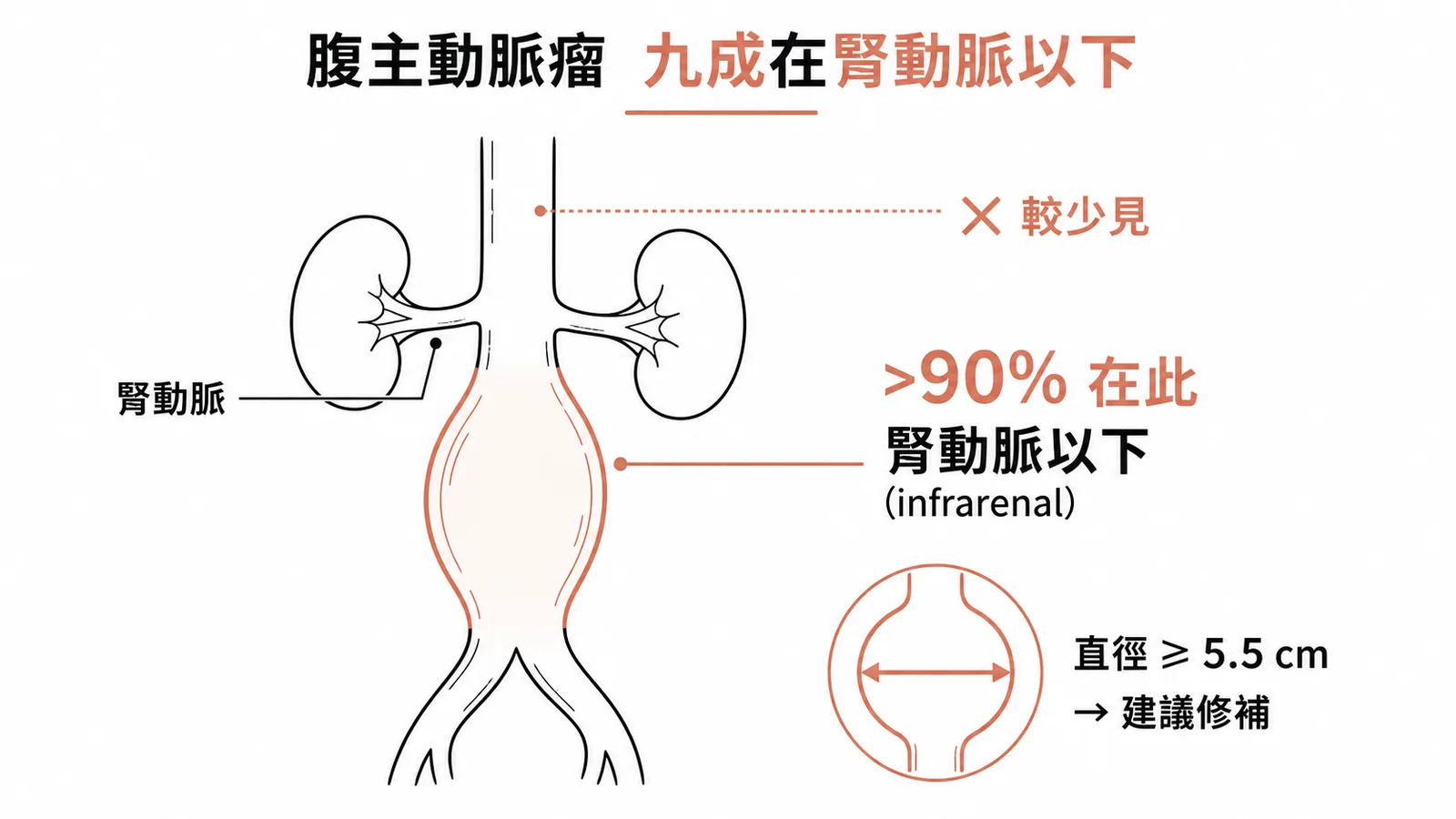 腹主動脈瘤好發位置：九成以上在腎動脈以下，直徑達5.5公分建議修補