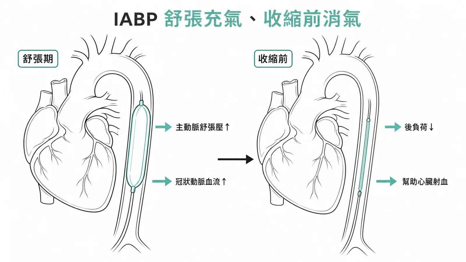 IABP運作原理：舒張期充氣增加冠脈灌注，收縮前消氣降低後負荷
