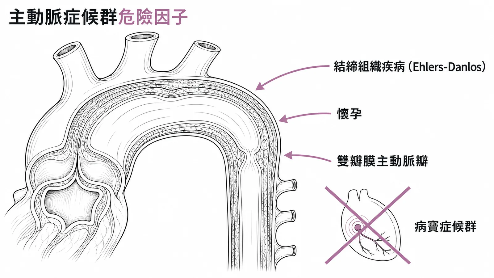 急性主動脈症候群危險因子:結締組織疾病、懷孕、雙瓣膜主動脈瓣為危險因子,病竇症候群無關