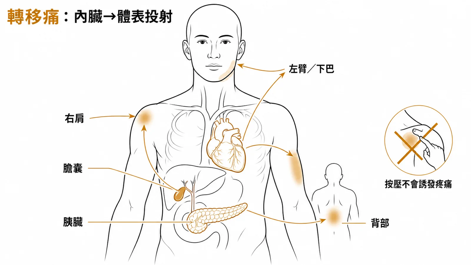 轉移痛經典投射路線:心臟→左臂下巴、膽囊→右肩、胰臟→背部,按壓轉移區不會誘發疼痛